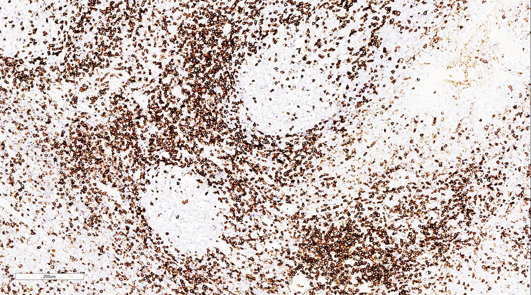 ZM-0055-3ml CD45RO抗体试剂（免疫组织化学） - ZSGB-BIO/中杉金桥