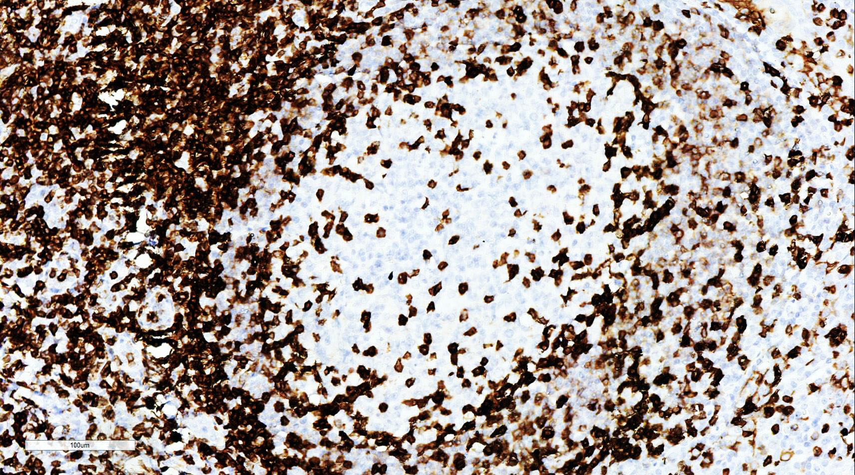ZM-0280-0.2ml CD5抗体试剂（免疫组织化学） - ZSGB-BIO/中杉金桥