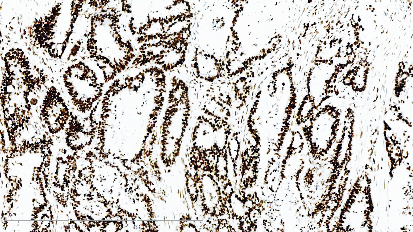 ZM-0367-1.5ml MSH6抗体试剂（免疫组织化学）